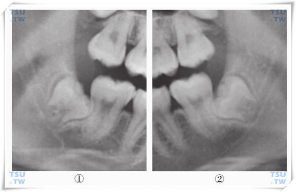  智齿损害威胁期X线片