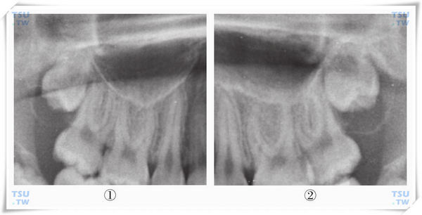  智齿损害期X线片