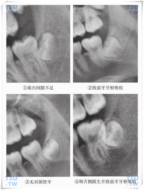 智齿预防性拔除的适应证