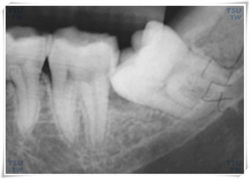  根尖片：下颌近中倾斜中位阻生智齿