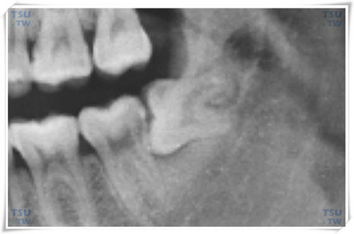  曲面断层片（剪摄）：下颌水平中位阻生智齿