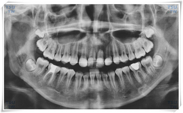 阻生智齿的诊断依据