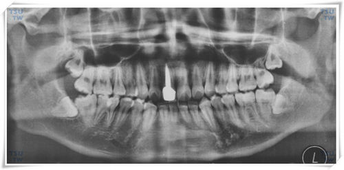 智齿口腔曲面断层片