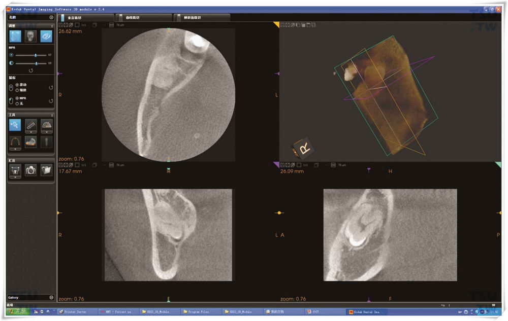 某公司CBCT软件，阻生智齿多平面重组功能图像，轴位、冠状位、矢状位、三维重建