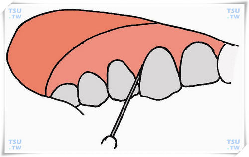    牙周膜注射法