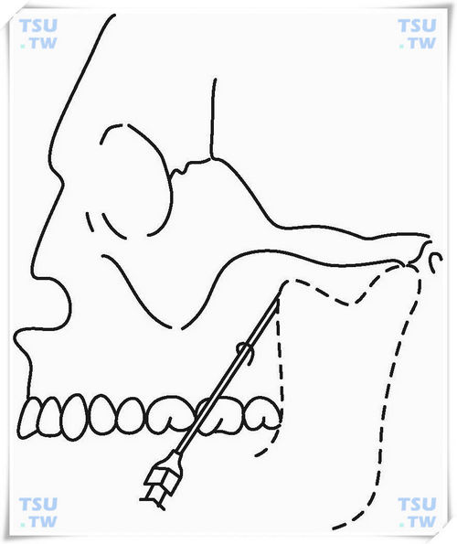  上牙槽后神经阻滞麻醉口内注射法