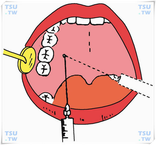 阻滞麻醉法:上牙槽后神经,腭前,上颌,下牙槽神经注射