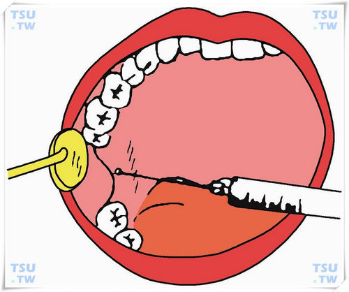  下牙槽神经阻滞麻醉口内注射法进针标志