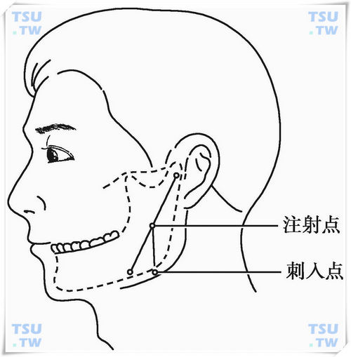 面部局麻怎么注射图解图片