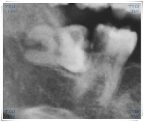  双根牙智齿，牙根的分叉较高，分叉度较大