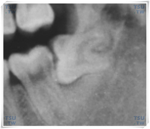  多根智齿，远中根肥大