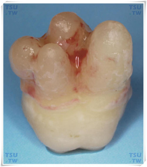 阻生智齿的术前阻力分析：牙根的阻力