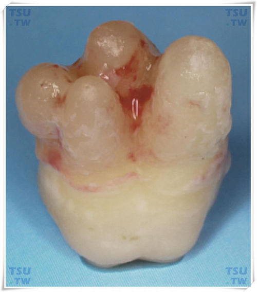  多根智齿，根肥大