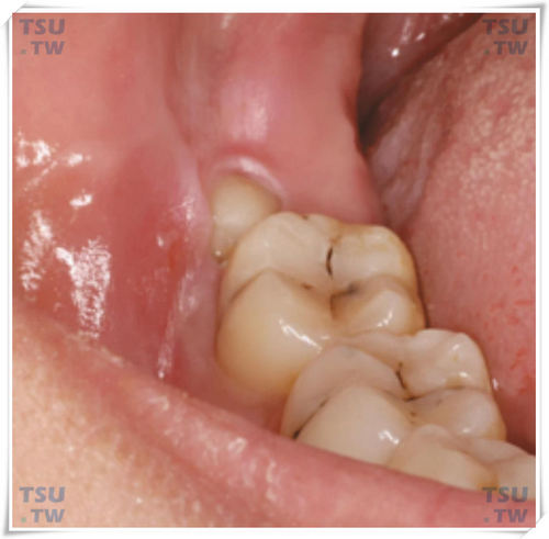 阻生智齿的术前阻力分析：牙阻力