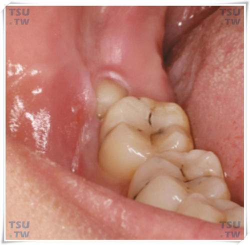  近中阻生智齿，第二磨牙产生了对智齿萌出的阻力