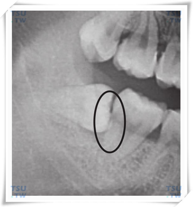  X线片示近中阻生智齿，第二磨牙产生了对智齿萌出的阻力
