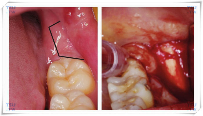 智齿拔除术切口的类型