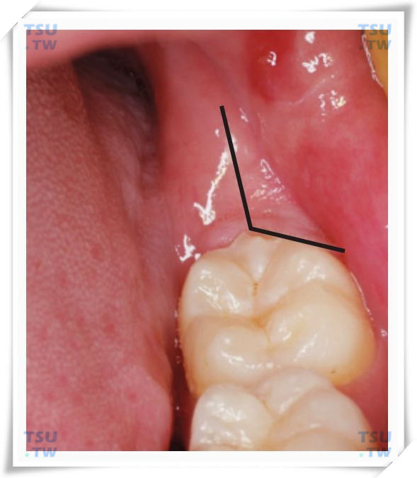 牙龈切除手术图解图片