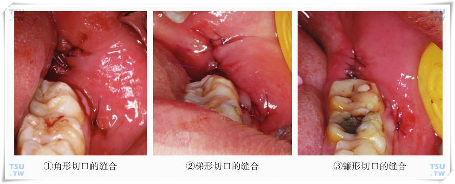 口腔锚式缝合图片