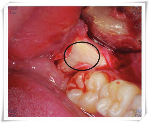 智齿拔牙圆形去骨