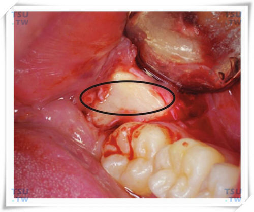 智齿拔牙椭圆形去骨