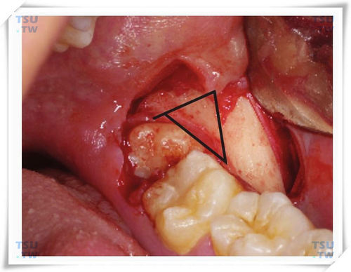 智齿拔牙角形去骨