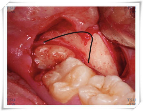 智齿拔牙半圆形去骨