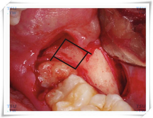 智齿拔牙方形去骨