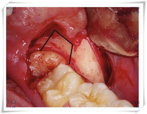 智齿拔牙长方形去骨
