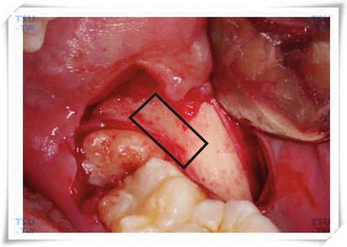 智齿拔牙梯形去骨