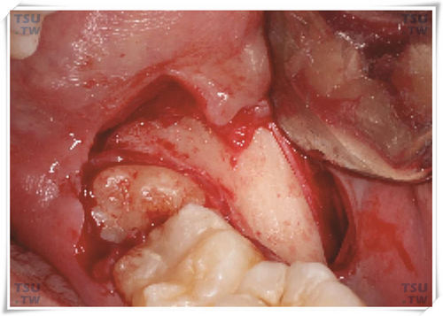 智齿拔牙条形去骨
