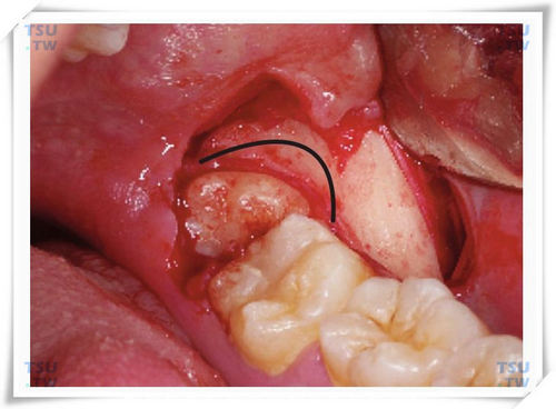 智齿拔牙月牙形去骨
