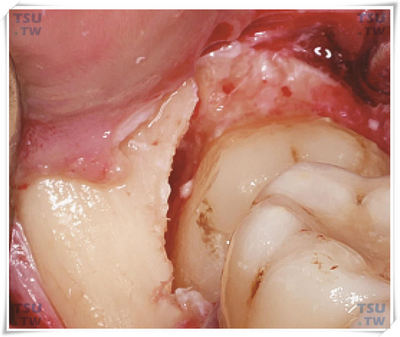 智齿拔除手术增隙