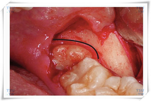 智齿拔牙镰形增隙