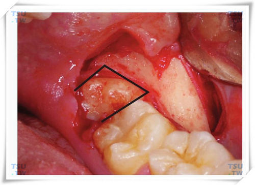 智齿拔牙梯形增隙