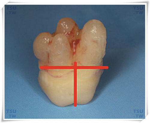 拔牙分牙：冠颈丁字切
