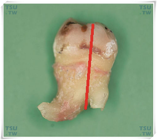 拔牙分牙：纵分根
