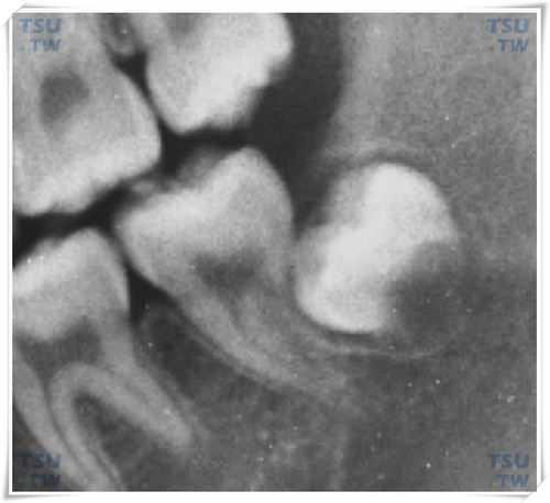 智齿预防性拔除Ⅰ期X线片