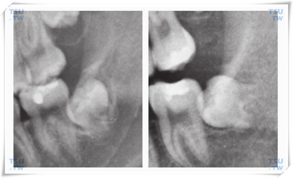 智齿预防性拔除Ⅲ期——根形成早期