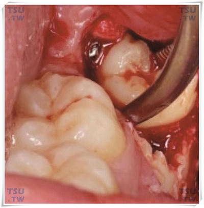  用止血钳取出智牙