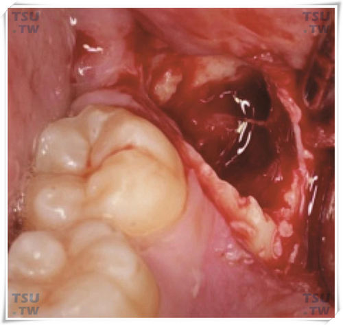 阻生智齿拔除后的牙槽窝