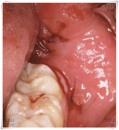  智齿拔牙后缝合