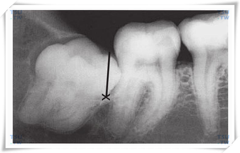  下颌近中倾斜中位阻生智齿X线片