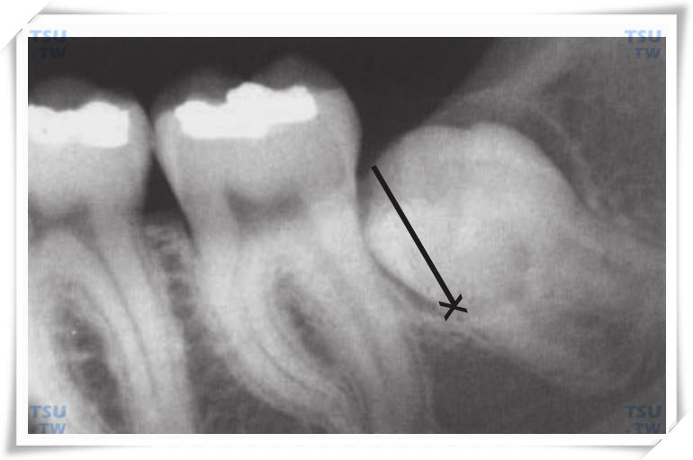 下颌近中倾斜中位阻生智齿X线片