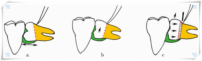  下颌水平阻生智齿切割牙冠示意图