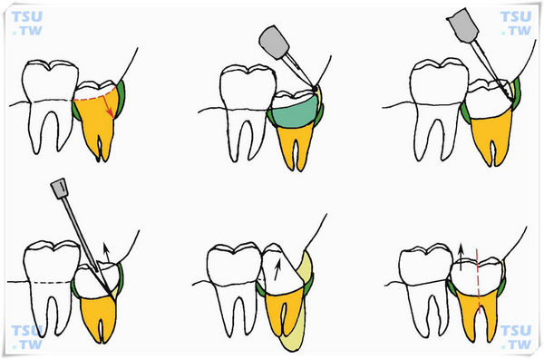  下颌垂直阻生智齿切割牙体的过程示意图