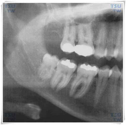  下颌垂直阻生智齿X线片