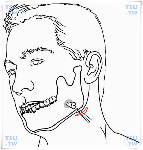 近下颌骨下缘异位阻生智齿拔除