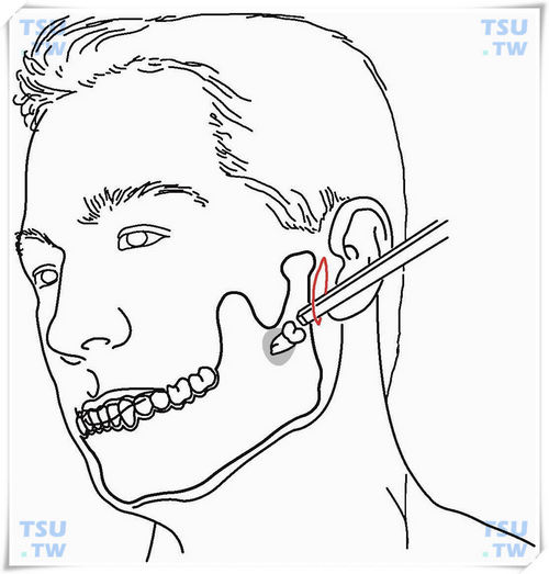 喙突附近或近髁状突异位阻生智齿拔除