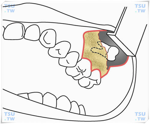  上颌骨后部阻生智齿手术示意图